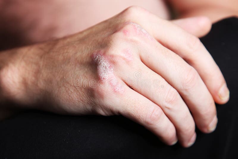 Severe Psoriasis Psoriasis on the Hand Stock Photo Image of health