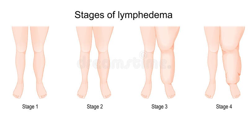 Severity of lower extremity lymphedema in different stages.