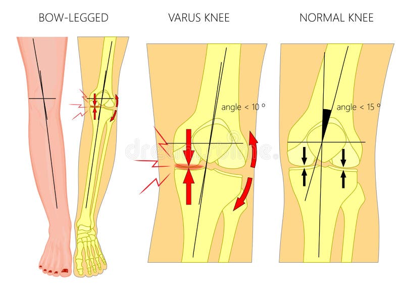 Shapes of the legs.Normal and curved legs.Knock knees.Bowed leg