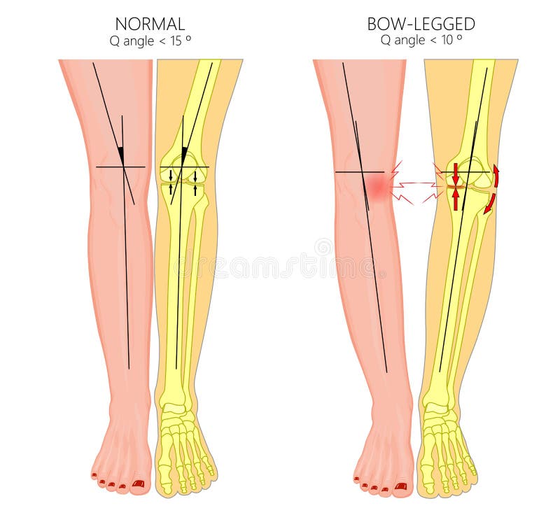 Shapes of the legs.Normal and curved legs.Knock knees.Bowed leg