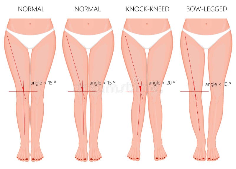 Shapes of the legs. Normal and curved legs. Knock knees. Bowed leg