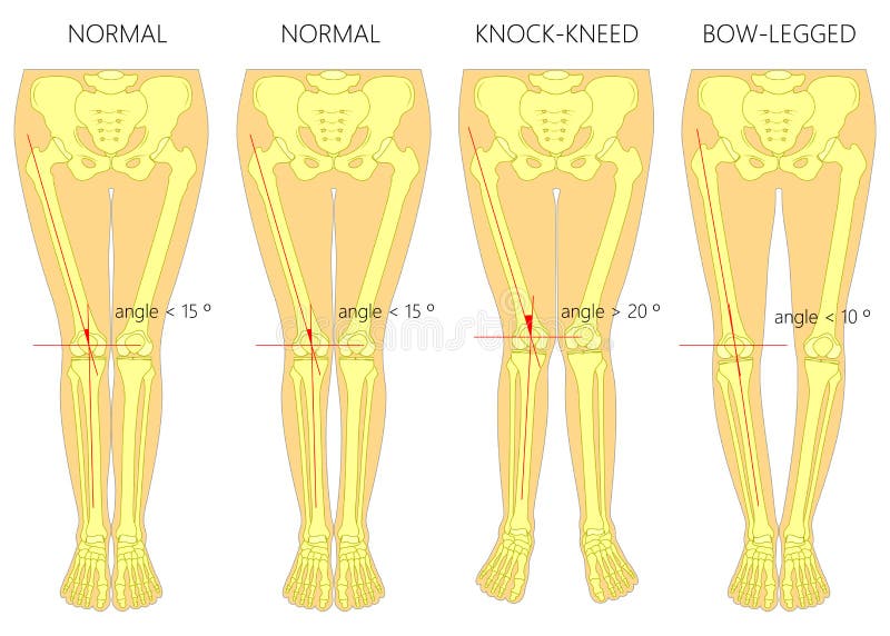 shapes of the legs normal and curved legs knock knees bowed leg genu valgum