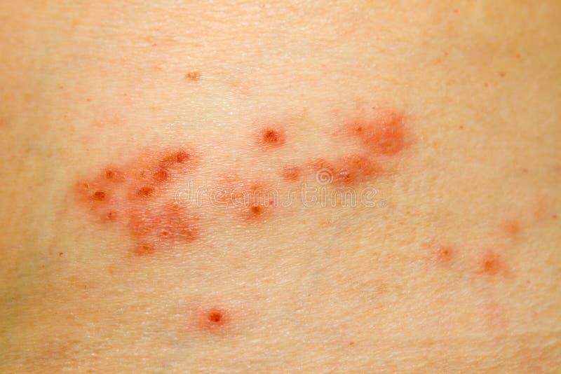 Lieve caso di herpes zoster eruzione cutanea sul lato del corpo.