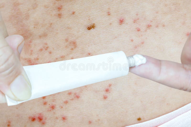 Skin Disease Prickly Heat Rash or Miliaria on Back Skin of Asian