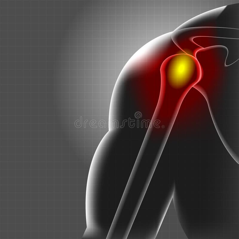 Arm Pain Stock Illustrations 11,360 Arm Pain Stock Illustrations