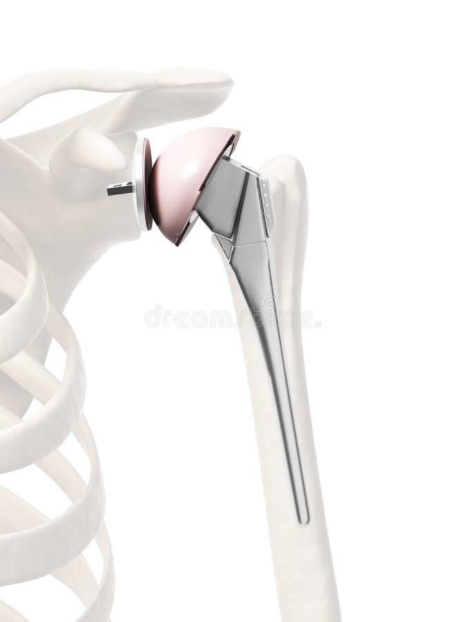 Shoulder replacement vector illustration