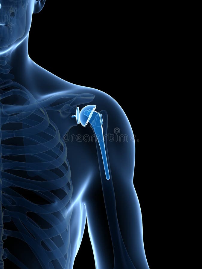 Shoulder replacement royalty free illustration