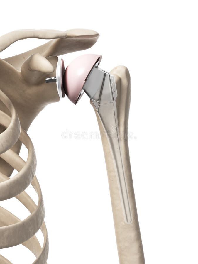 Shoulder replacement vector illustration