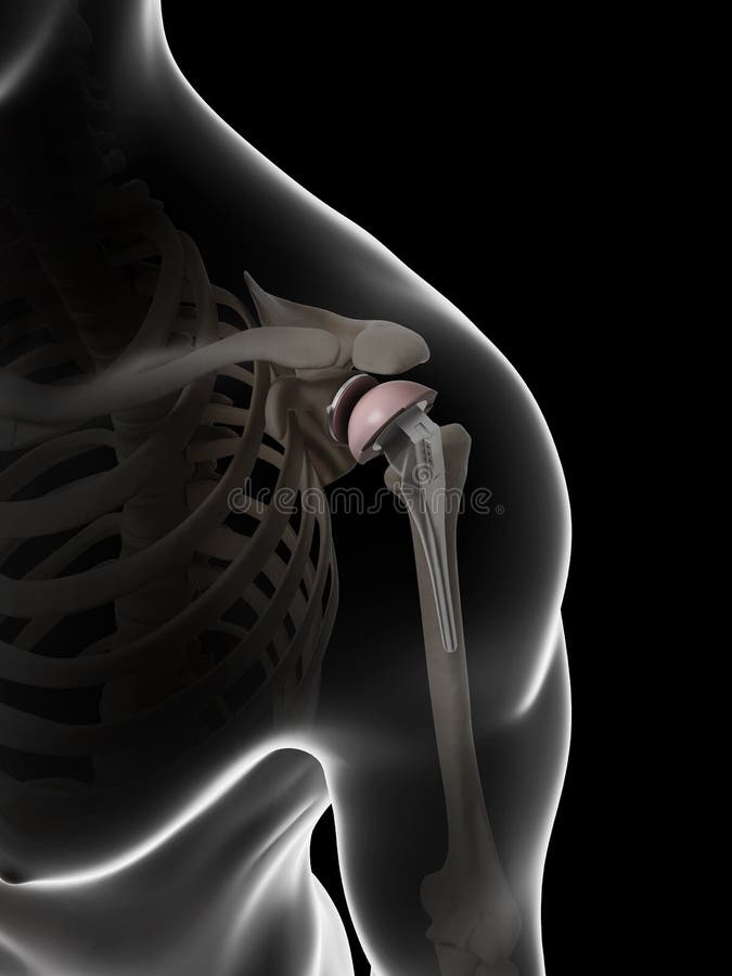 Shoulder replacement royalty free illustration