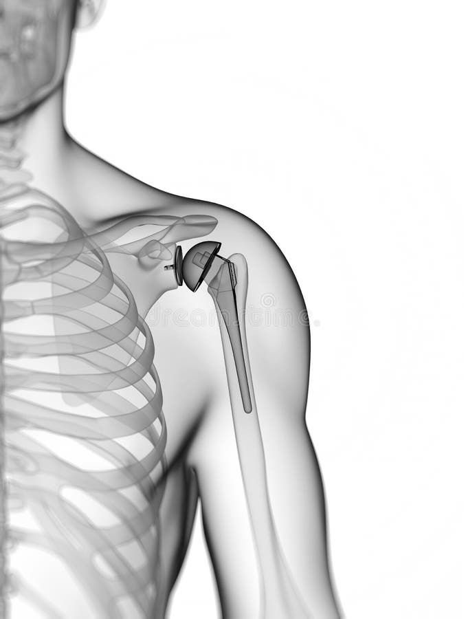 Shoulder replacement vector illustration
