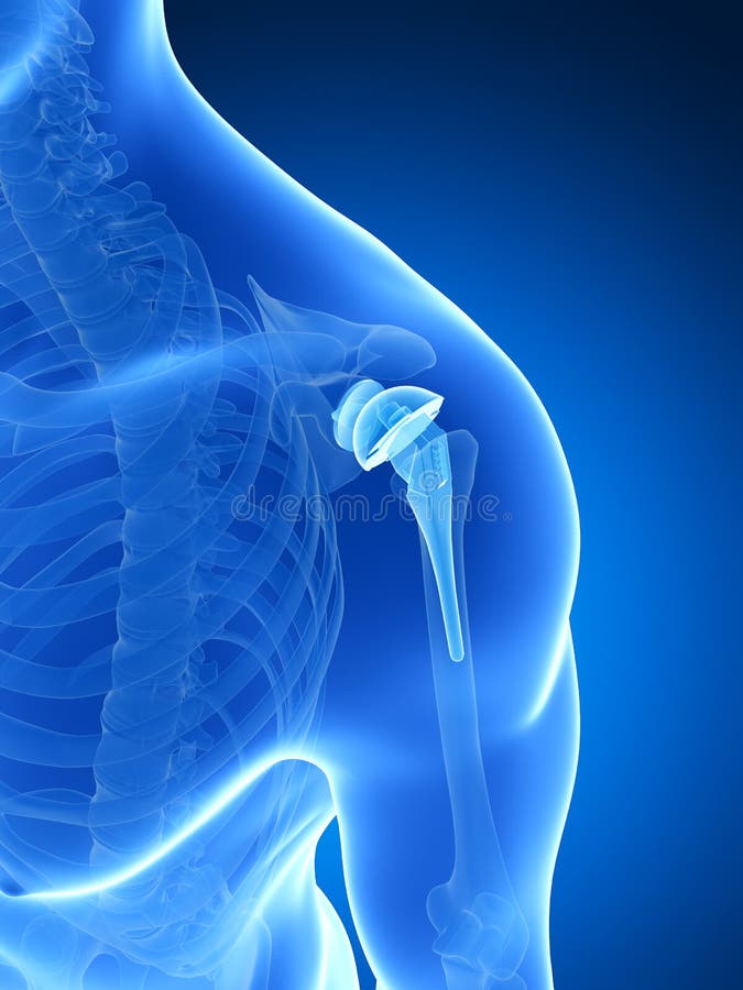 Shoulder replacement stock illustration