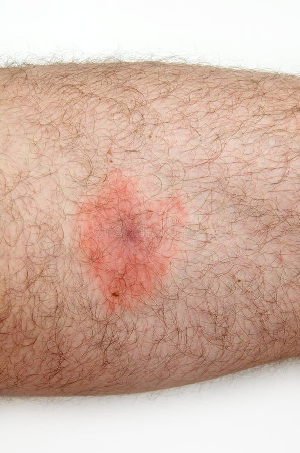 Man infected by lyme disease, detail of red spot on his skin. Man infected by lyme disease, detail of red spot on his skin.