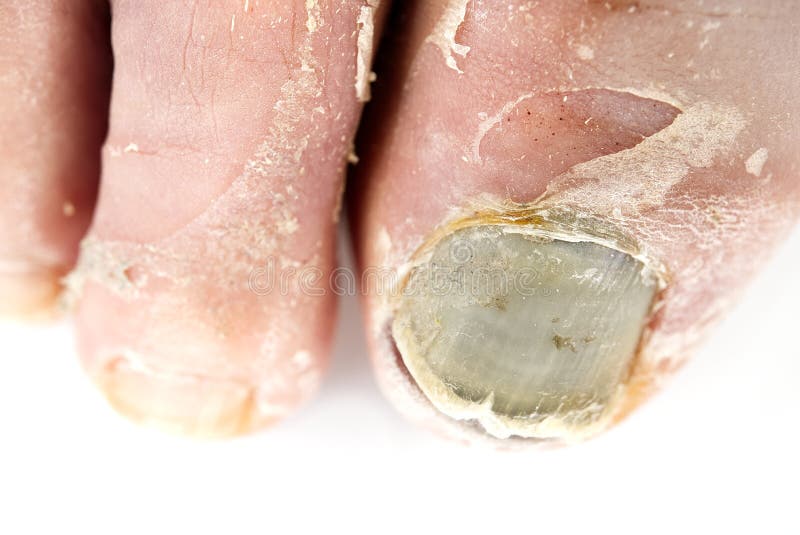 lábgomba ellen hazilag a belső szervek károsodása körömgombával