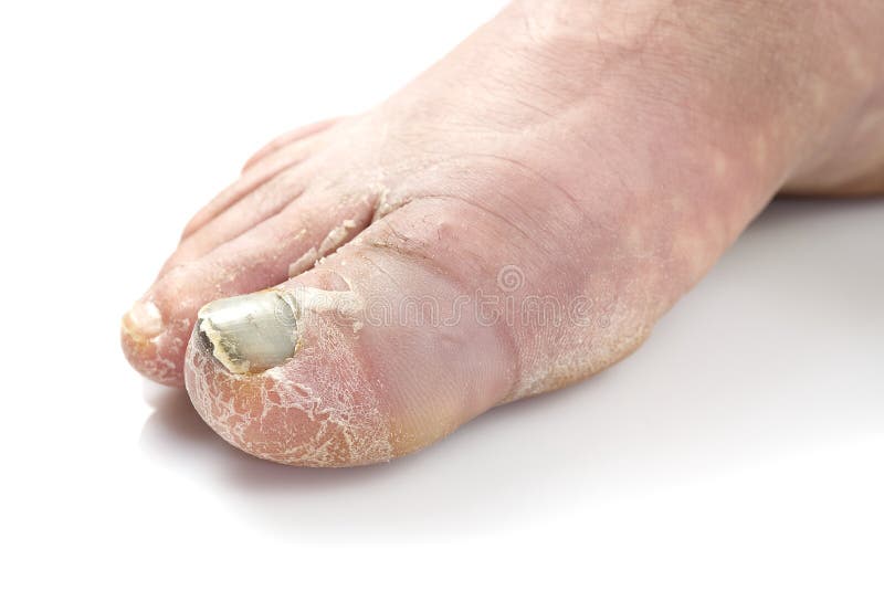 Sick Nail on the Foot. Toenail Fungus Isolated on White. Sore Toenail ...