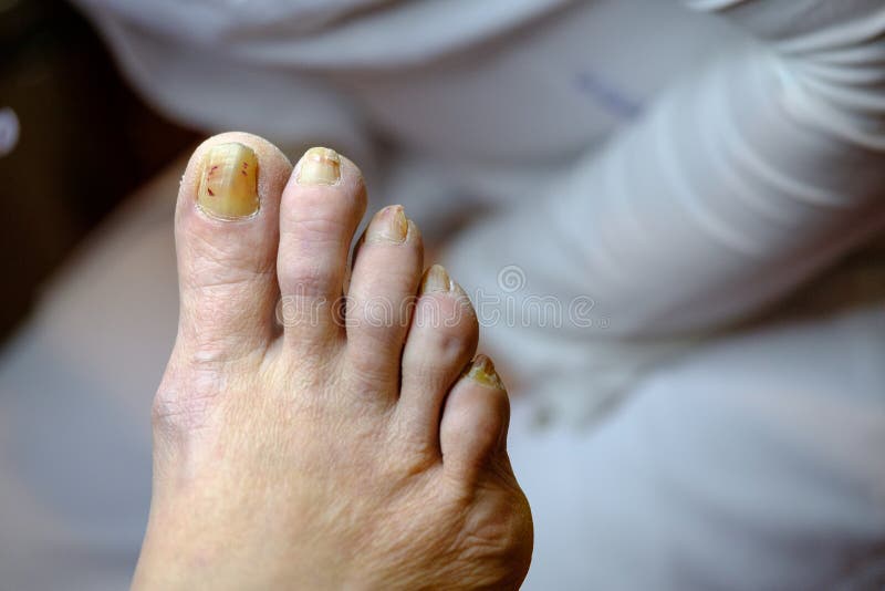 Sick Unhealthy Nails on the Foot of a Man Stock Photo Image of dirty
