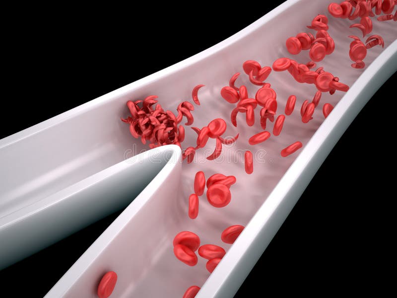 Sickle Cells Blocking Blood Flow