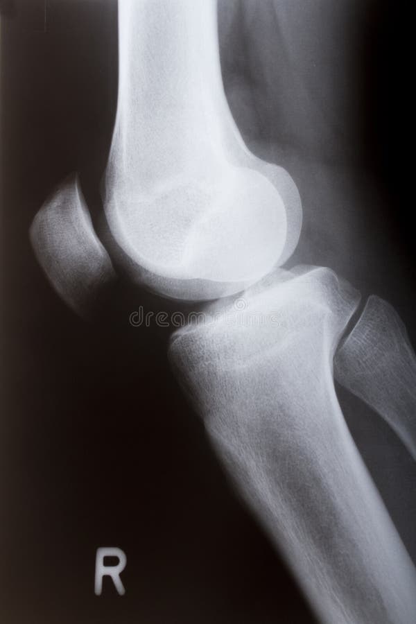 Human knee sidelong in x-ray. Human knee sidelong in x-ray