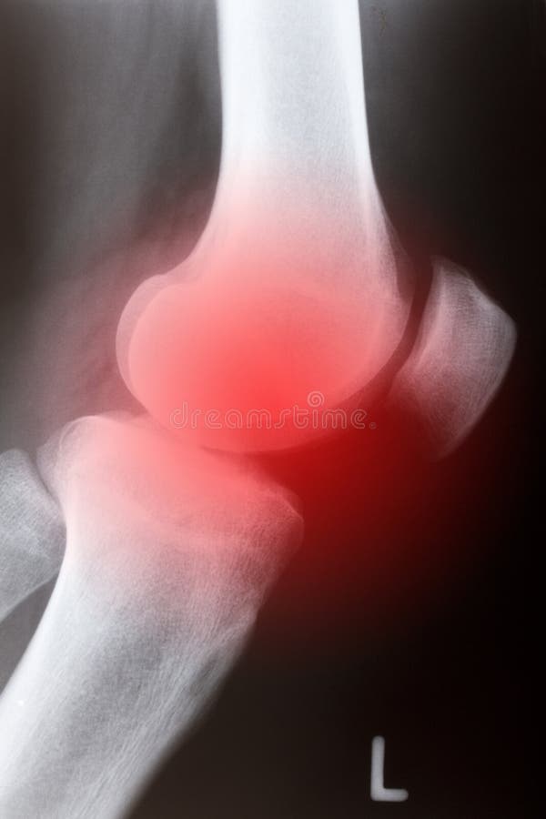 Human knee sidelong in x-ray. Human knee sidelong in x-ray