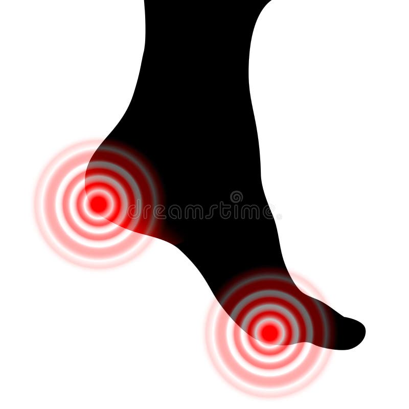 Silhouette of Painful Sore Red Human Foot. Foot Health Concept. Vector ...