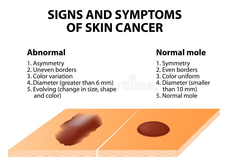 Sinais e sintomas do câncer de pele