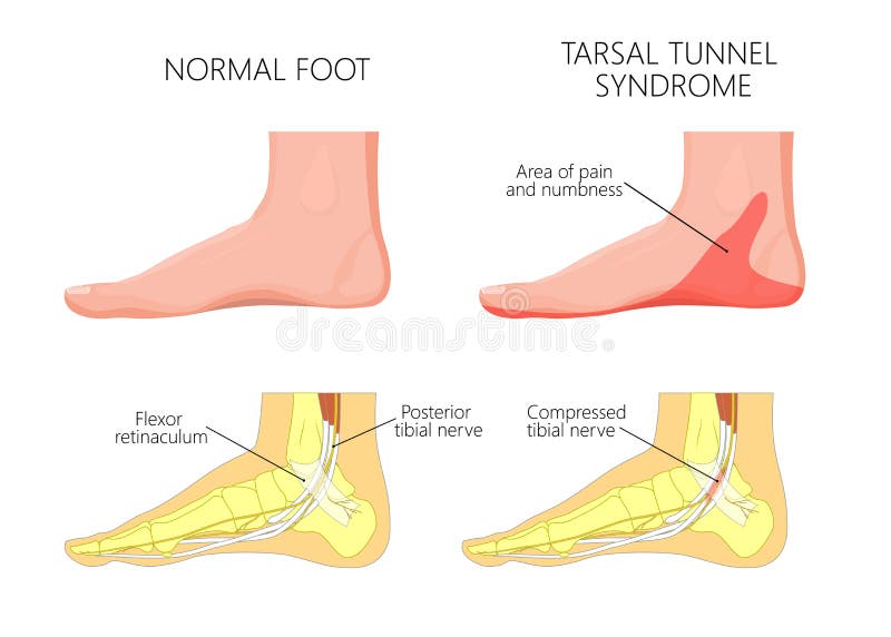 Sindrome injury_Tarsal del tunnel della caviglia mediale