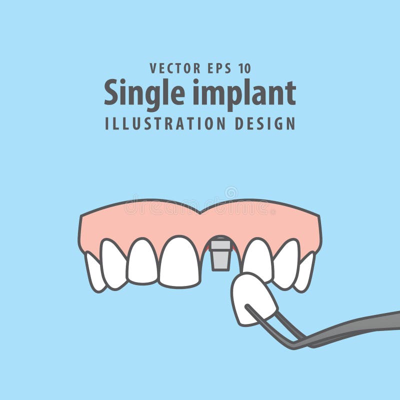 Single implant upper illustration vector on blue background. Den royalty free illustration Single implant upper illustration vector on blue background. Den royalty free illustration