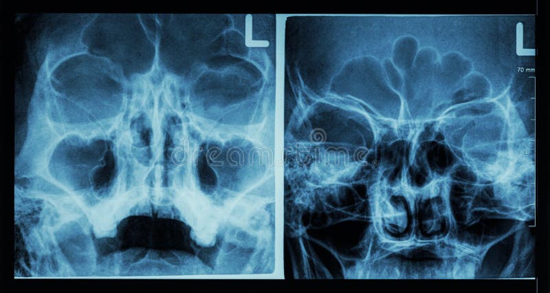 Sino frontal de la demostración del sino paranasal de la radiografía de la película, sino maxilar, sino etmoideo fotos de archivo libres de regalías Sino frontal de la demostración del sino paranasal de la radiografía de la película, sino maxilar, sino etmoideo fotos de archivo libres de regalías