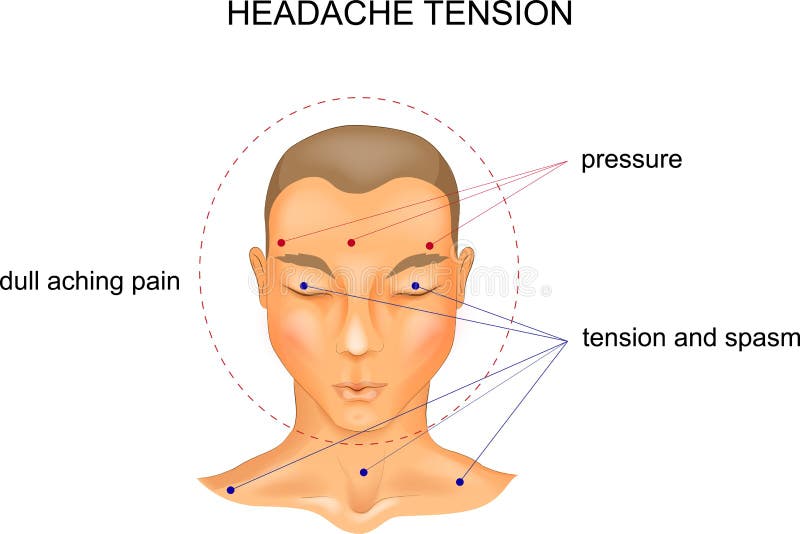 Vector illustration of tension headache symptoms. Vector illustration of tension headache symptoms