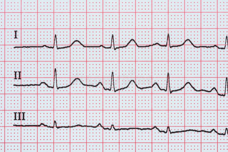 Sinus Heart Rhythm On Electrocardiogram Record Paper Showing Normal P Wave, PR and QT Interval and QRS Complex. Sinus Heart Rhythm On Electrocardiogram Record Paper Showing Normal P Wave, PR and QT Interval and QRS Complex