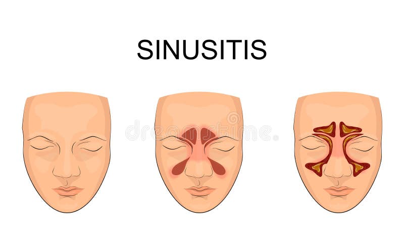 Sinus nasal inflammation illustration stock Sinus nasal inflammation illustration stock
