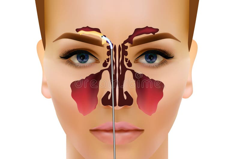 E Ojos De Hinchazon Sinusitis E Ojos De Hinchazon Sinusitis