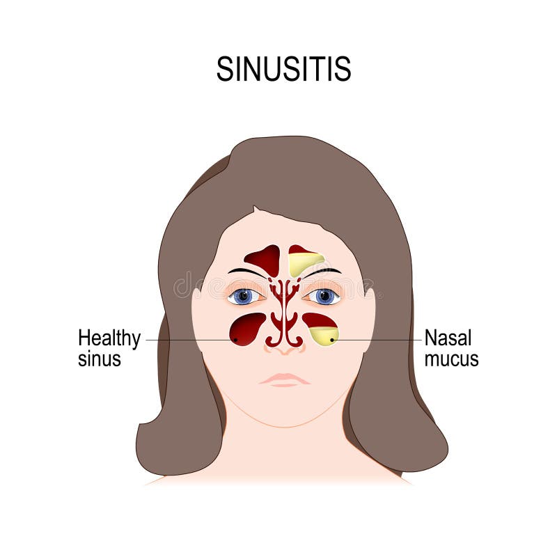 Sinusitis stock vector. Illustration of runny, nose, rhinitis 35869358