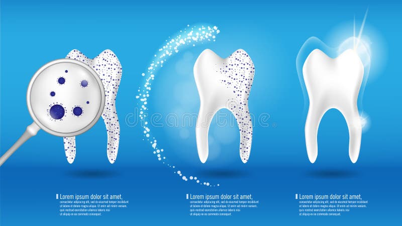 Sistema dental del vector del concepto de la salud diente limpio 3d y sucio brillante realista en fondo, el claro y blanquear azu ilustración del vector Sistema dental del vector del concepto de la salud diente limpio 3d y sucio brillante realista en fondo, el claro y blanquear azu ilustración del vector