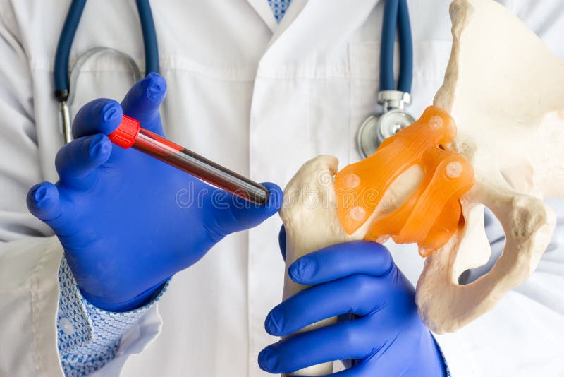 Medico Che Cura Le Ossa Concetto Del Cancro Alle Ossa La Forma Anatomica Dell'osso E Dell