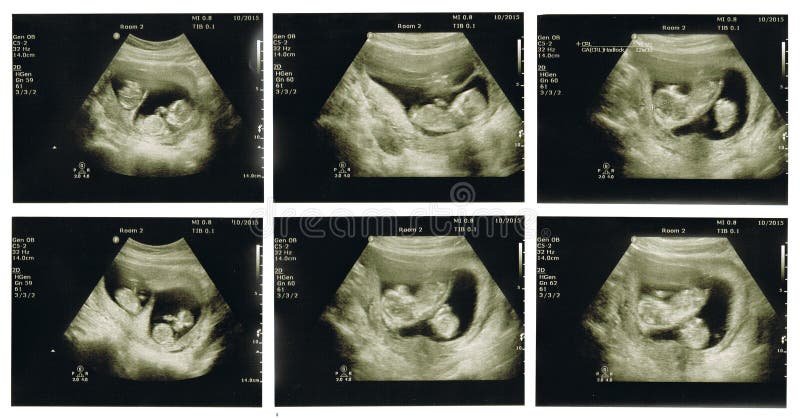 Six ultrasound scans of baby twins at 12 weeks