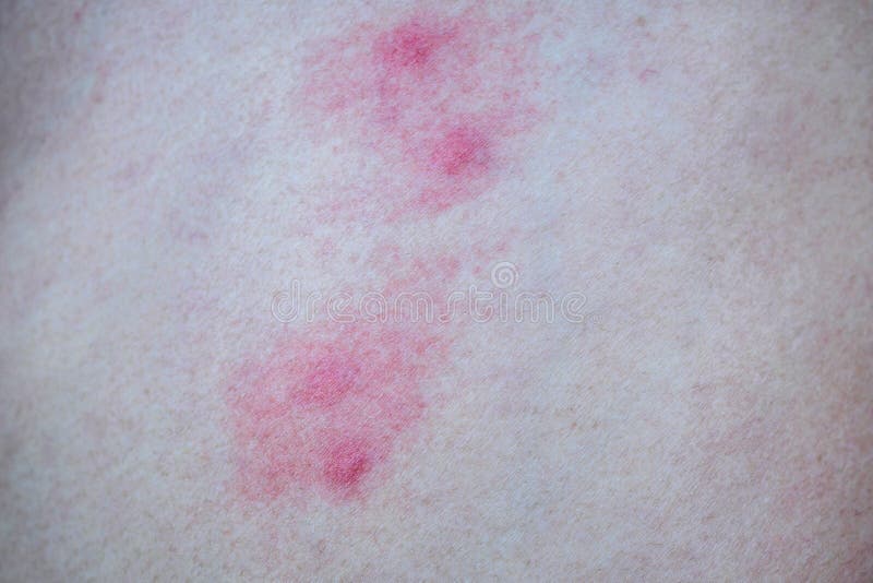 159 Mosquito Bites Sore Stock Photos - Free & Royalty-Free Stock Photos  from Dreamstime