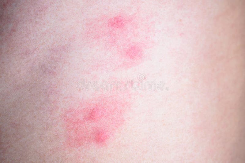 Skin Allergy With Rash After Mosquito Bite Stock Image Image Of