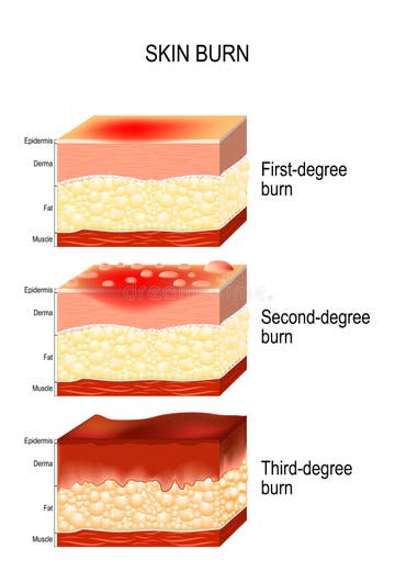 Chemical Burns Stock Illustrations 247 Chemical Burns Stock