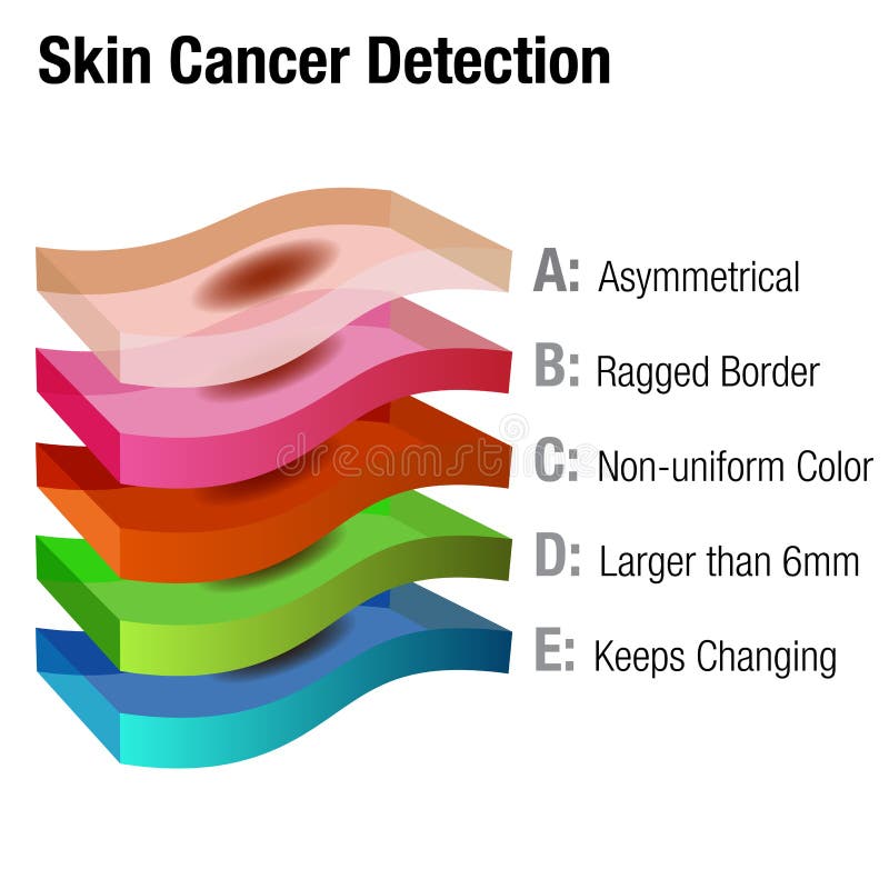 Abcde Cancer Chart