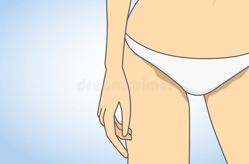 Skin discoloration around the groin stock illustration Skin discoloration around the groin stock illustration
