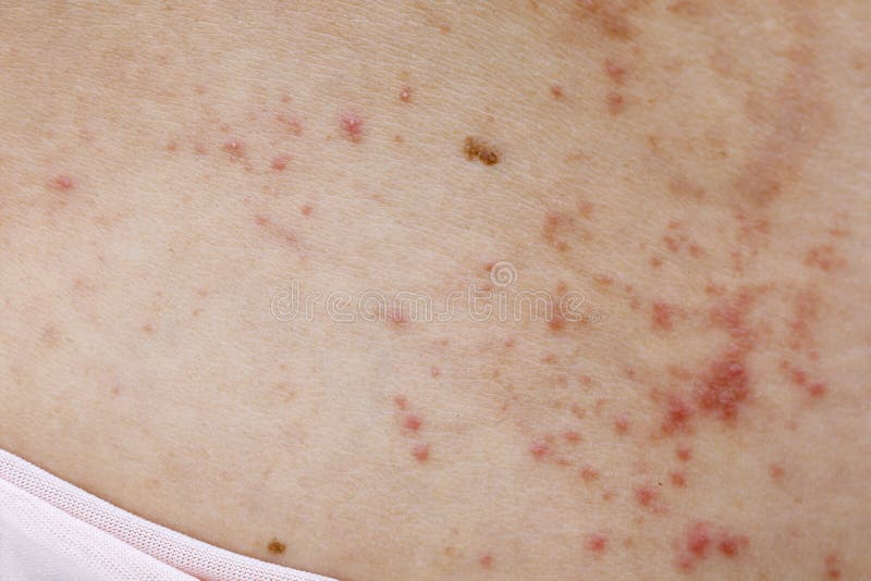 Reskyd fiktion virksomhed Skin Disease Prickly Heat Rash or Miliaria on Back Skin of Asian Woman.  Healthcare Skin Cause for Outdoor Work in Sunny with Hot Stock Image -  Image of health, cause: 183828587