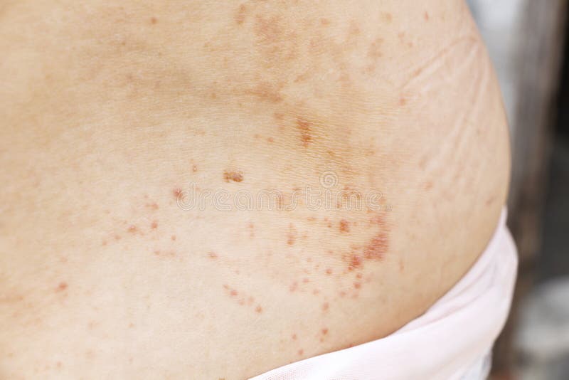 Skin Disease Prickly Heat Rash or Miliaria on Back Skin of Asian Woman.  Healthcare Skin Cause for Outdoor Work in Sunny with Hot Stock Photo -  Image of health, cracked: 183942210