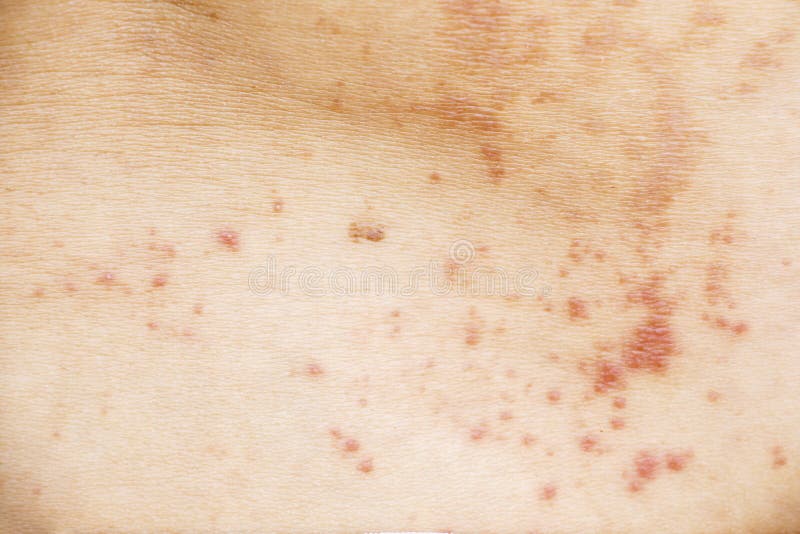 Skin Disease Prickly Heat Rash or Miliaria on Back Skin of Asian Woman.  Healthcare Skin Cause for Outdoor Work in Sunny with Hot Stock Photo -  Image of health, cracked: 183942210