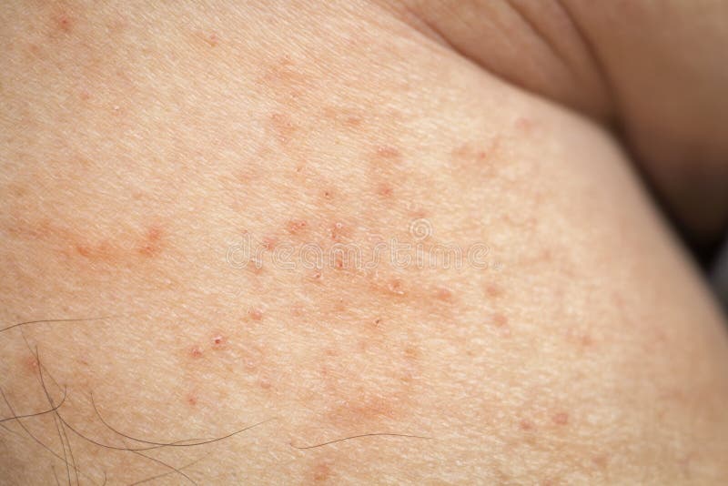Skin Disease Prickly Heat Rash or Miliaria on Back Skin of Asian