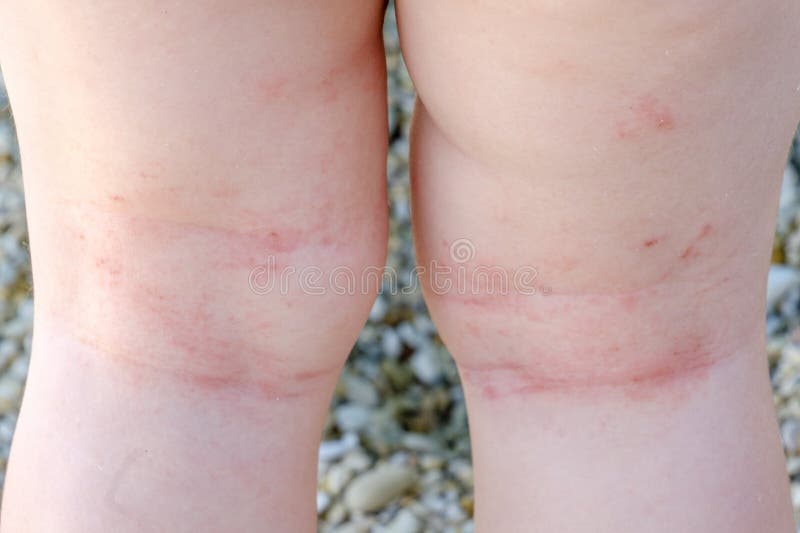 Skin irritation newborn closeup atopic dermatitis legs scratches