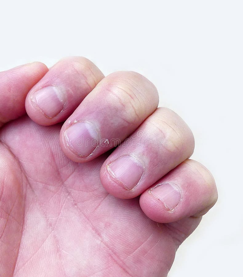 Vitamin Deficiency Finger Nail Stock Photos - Free & Royalty-Free Stock  Photos from Dreamstime