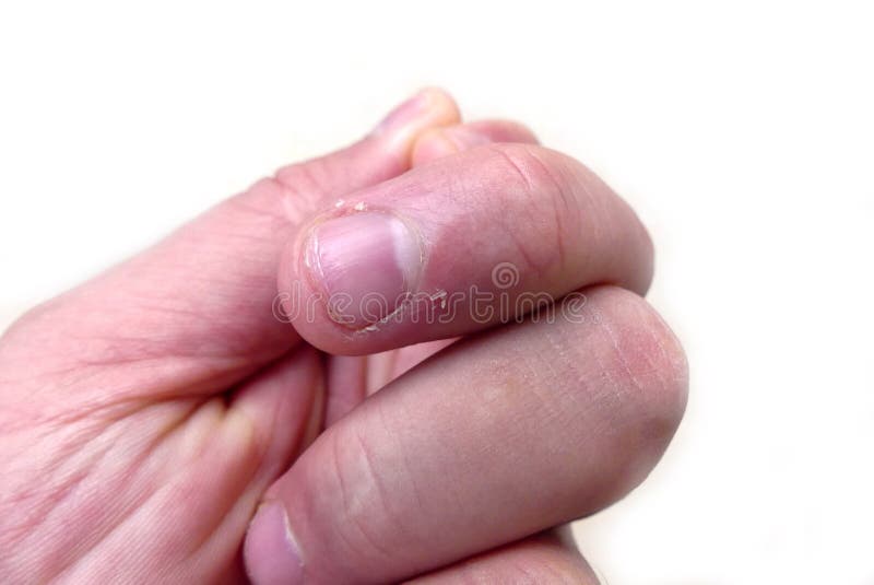 Vitamin Deficiency Finger Nail Stock Photos - Free & Royalty-Free Stock Photos from Dreamstime Vitamin Deficiency Finger Nail Stock Photos - Free & Royalty-Free Stock Photos from Dreamstime