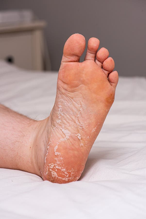 Skin peeling on the sole of a foot