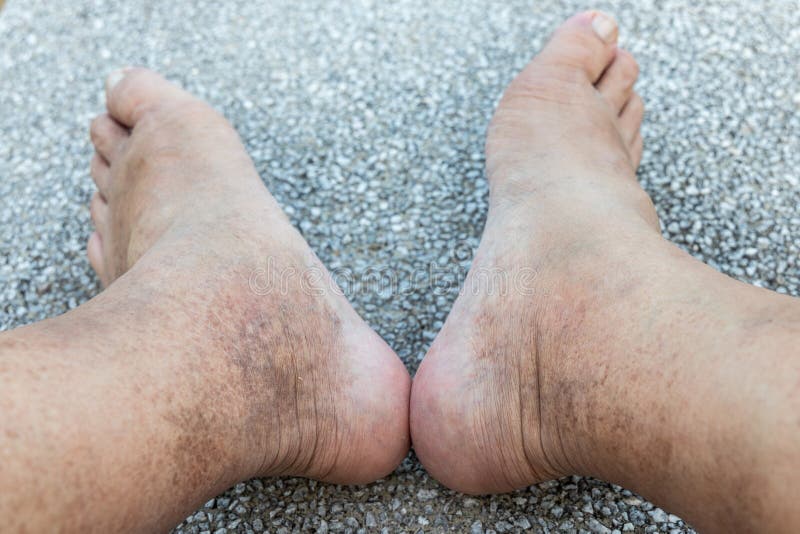 Skin pigmentation on neglected leg of matured male Asian royalty free stock images Skin pigmentation on neglected leg of matured male Asian royalty free stock images