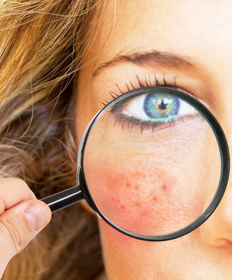 Skin problems stock image. Image of dermatitis, cosmetic - 57612163
